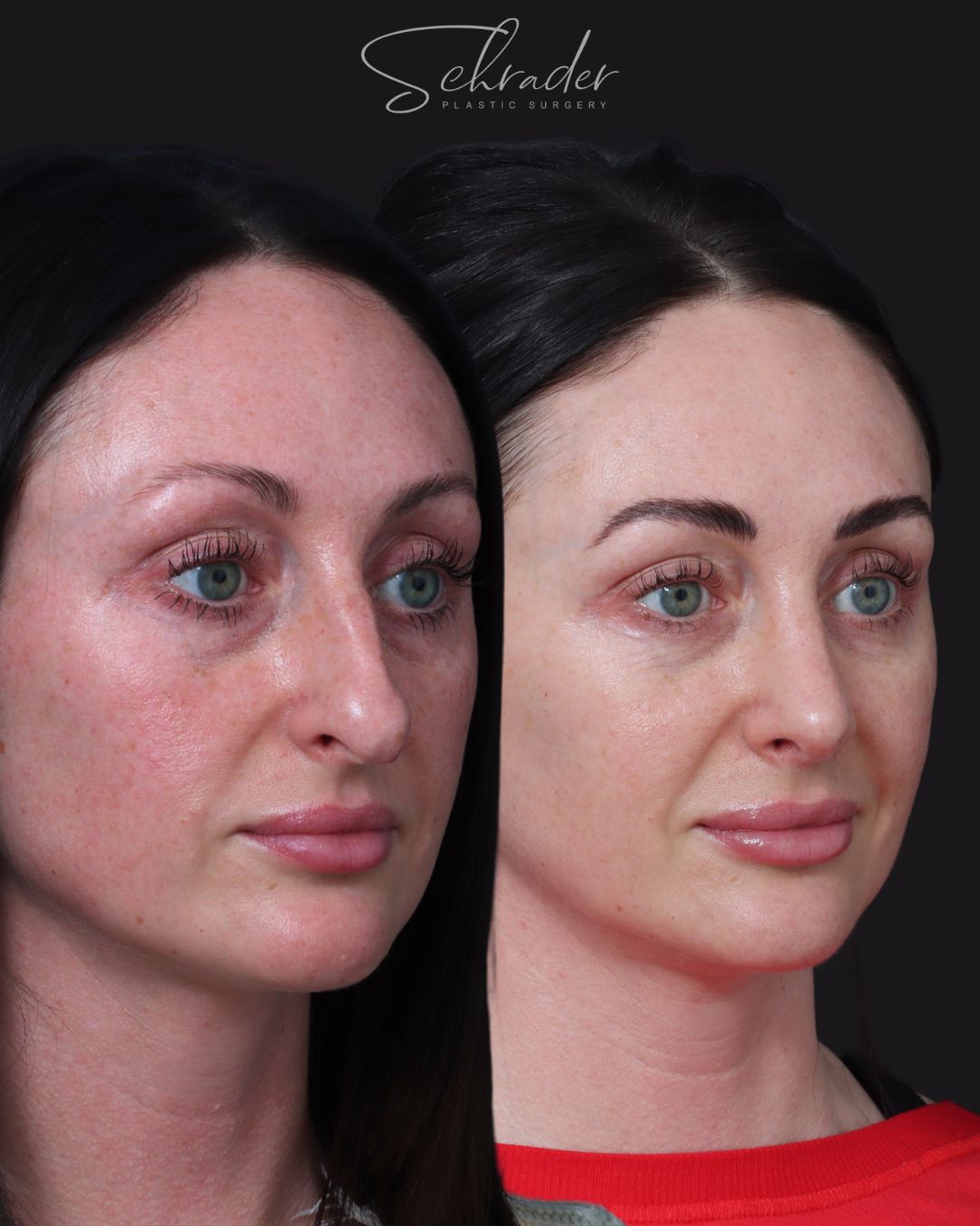 rhinoplasty-11-obl