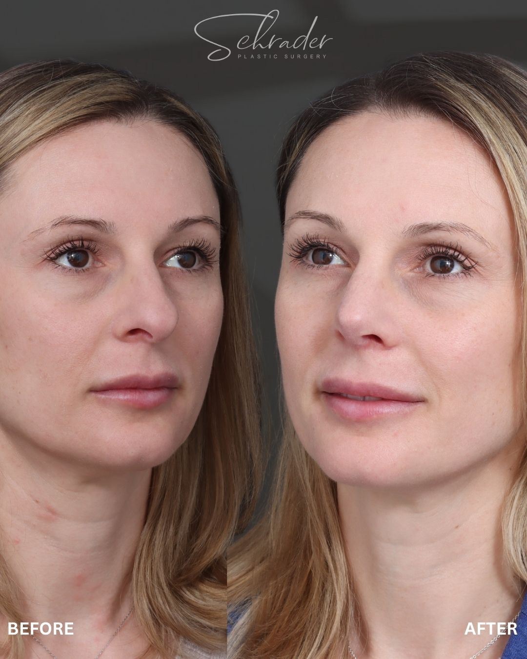 rhinoplasty-11-obl