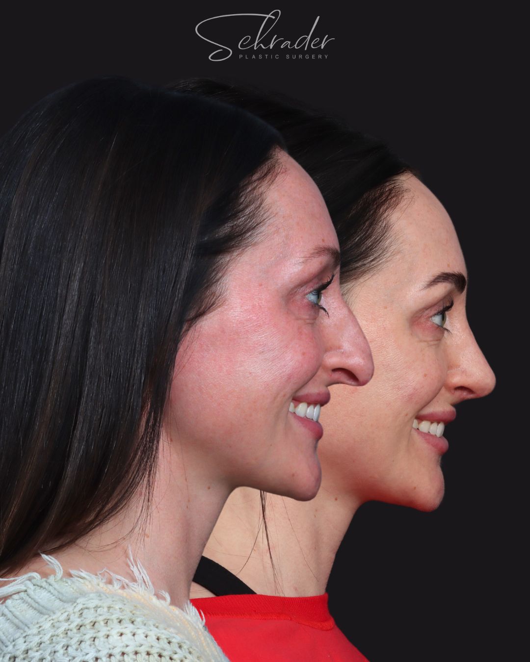 rhinoplasty-11-obl2