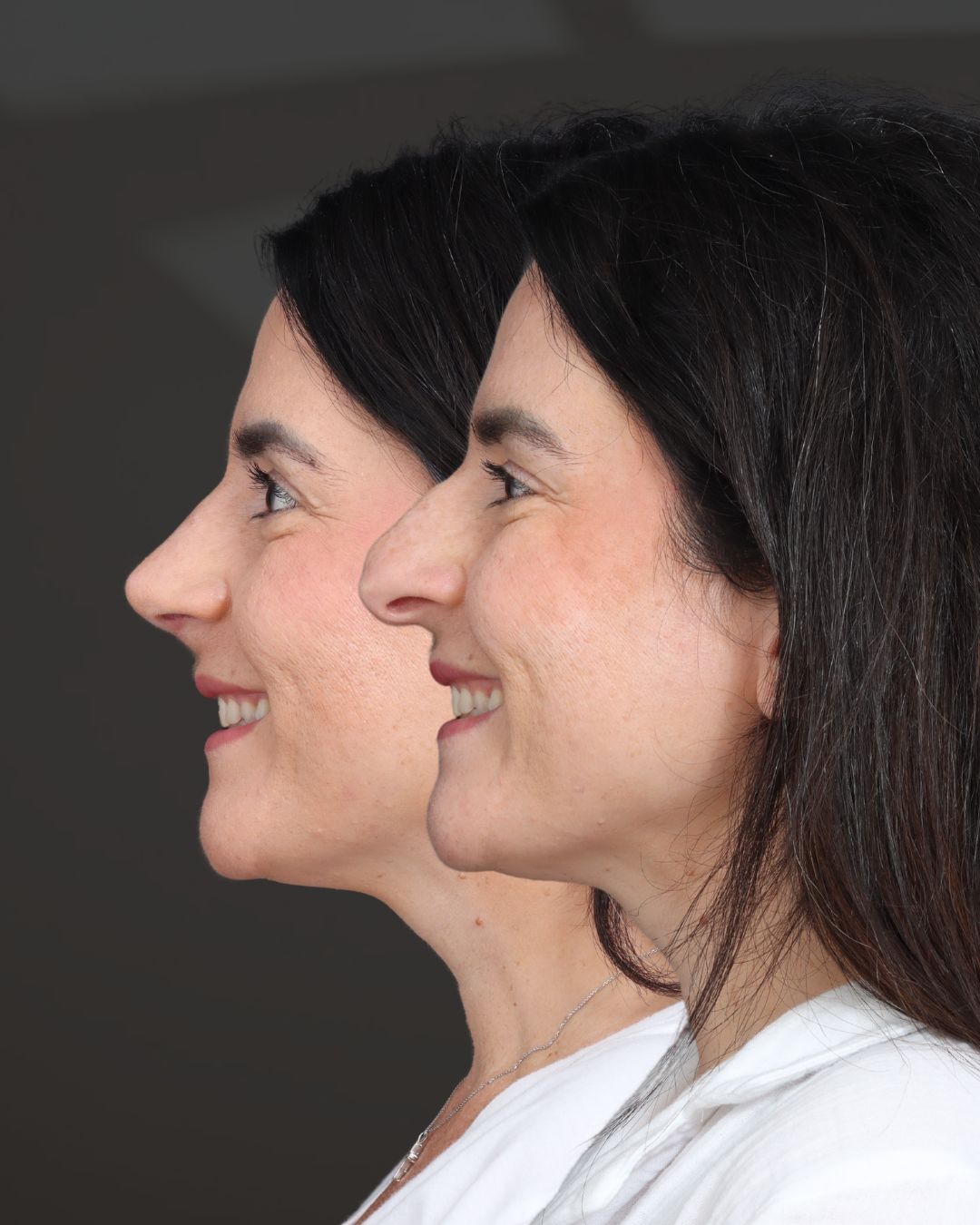 rhinoplasty-21-lat