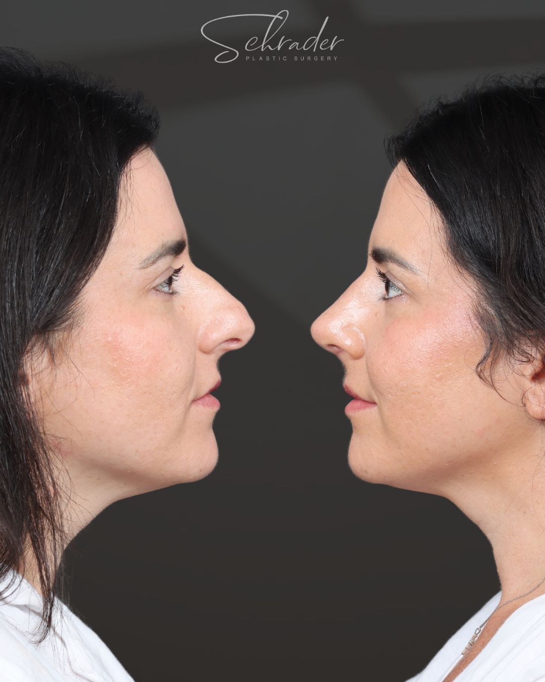 rhinoplasty-21-lat2