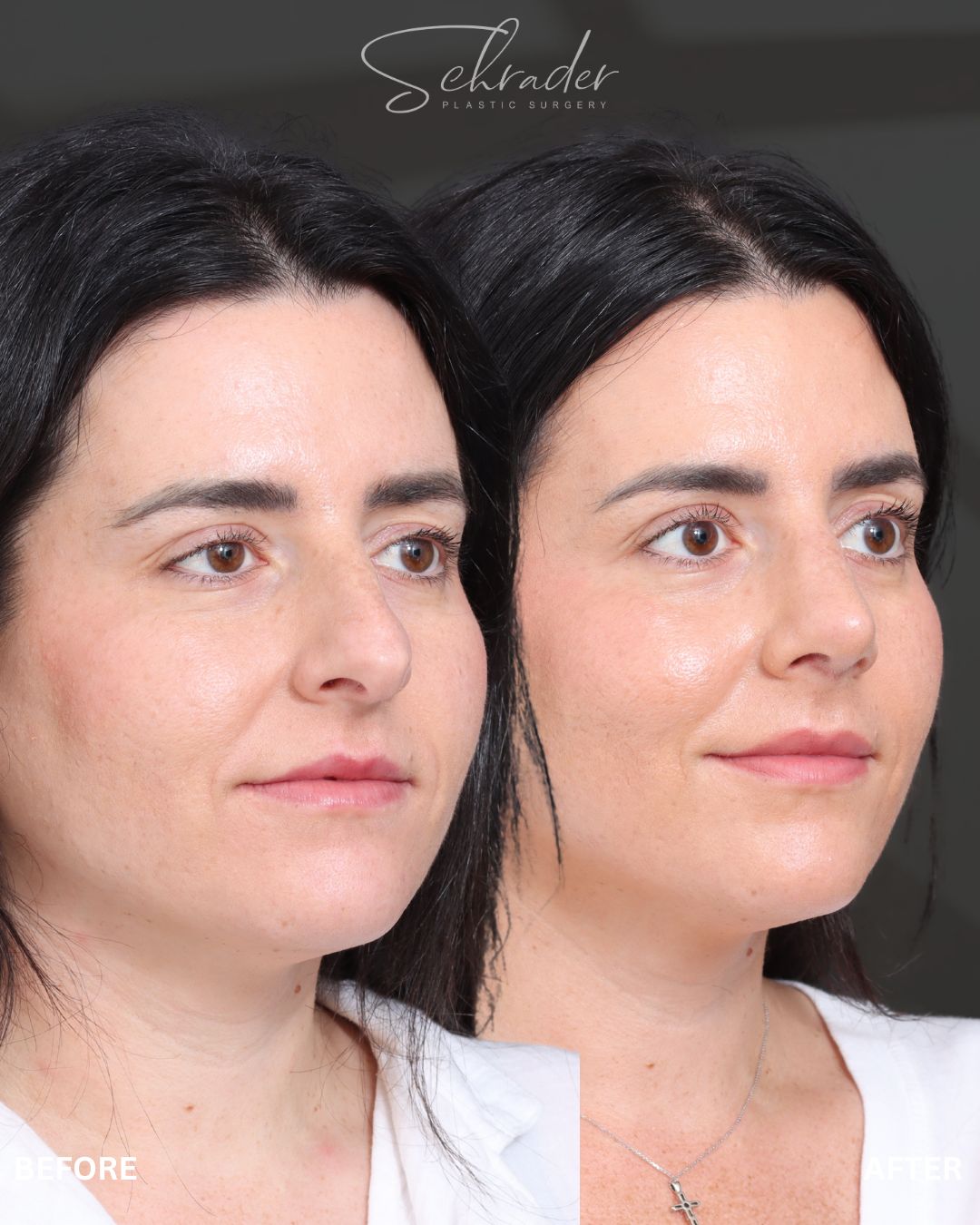 rhinoplasty-21-obl