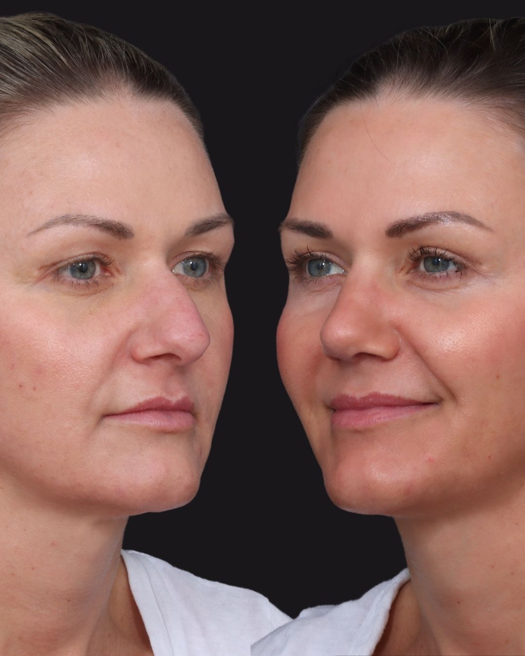rhinoplasty-21-obl2