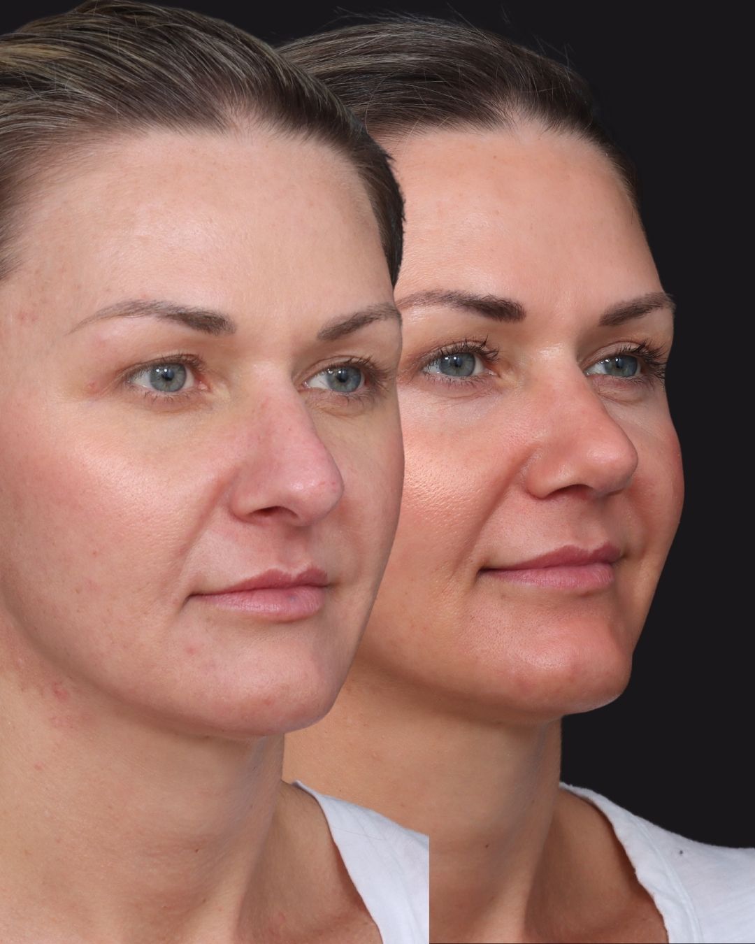 rhinoplasty-22-obl
