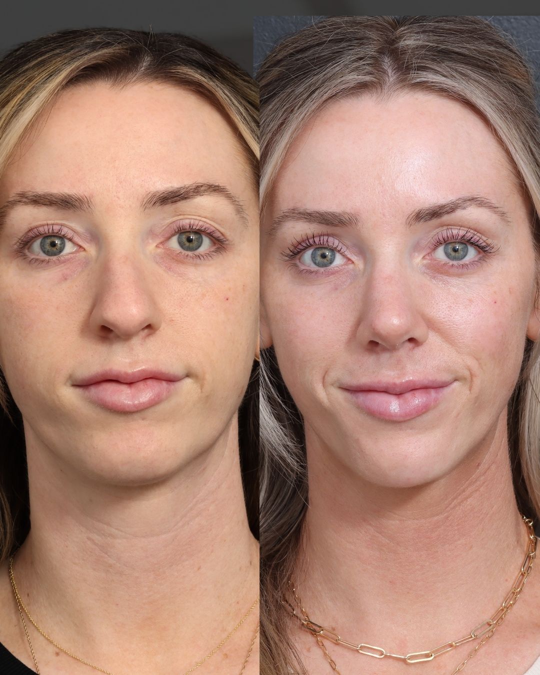 rhinoplasty-40-front