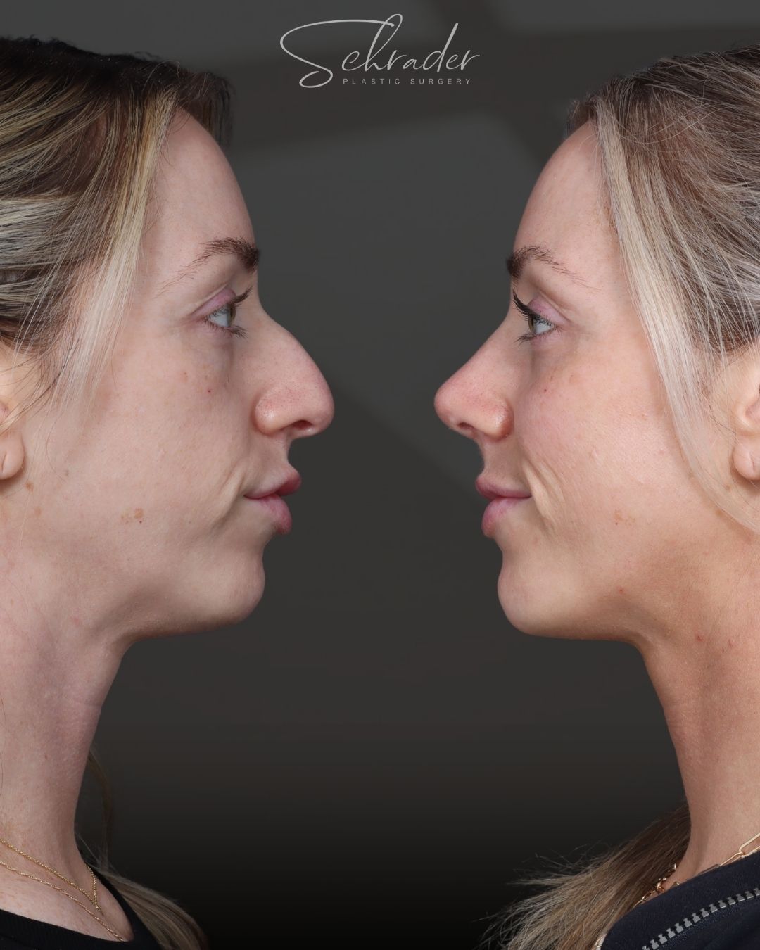 rhinoplasty-40-lat