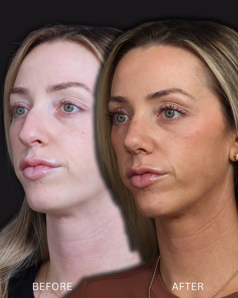 rhinoplasty-40-obl