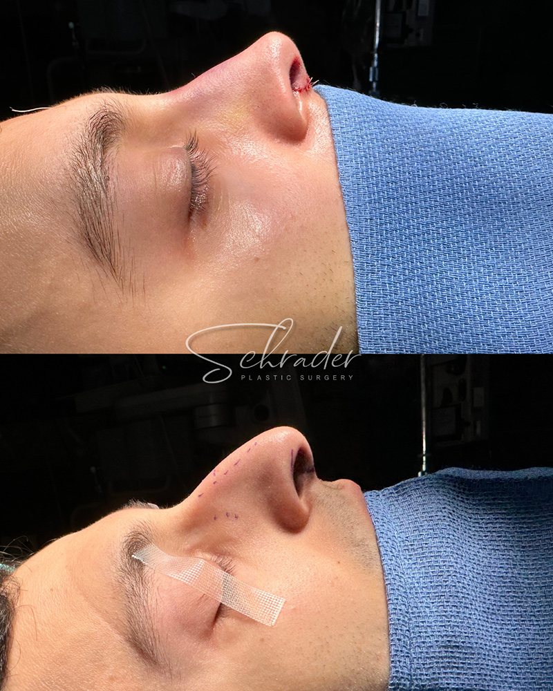 rhinoplasty-final