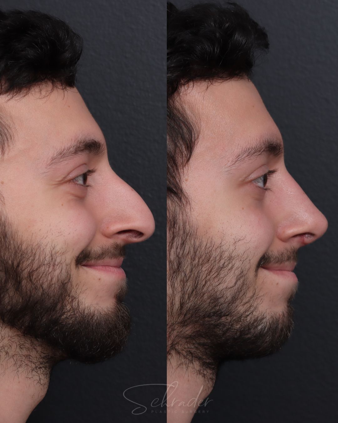 rhinoplasty-lat