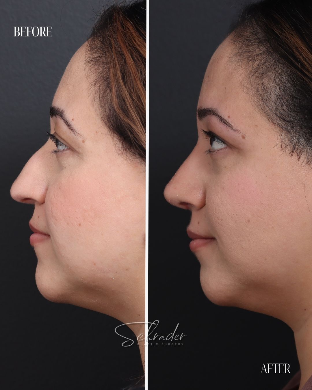 septoplasty-rhinoplasty-01-lat-left