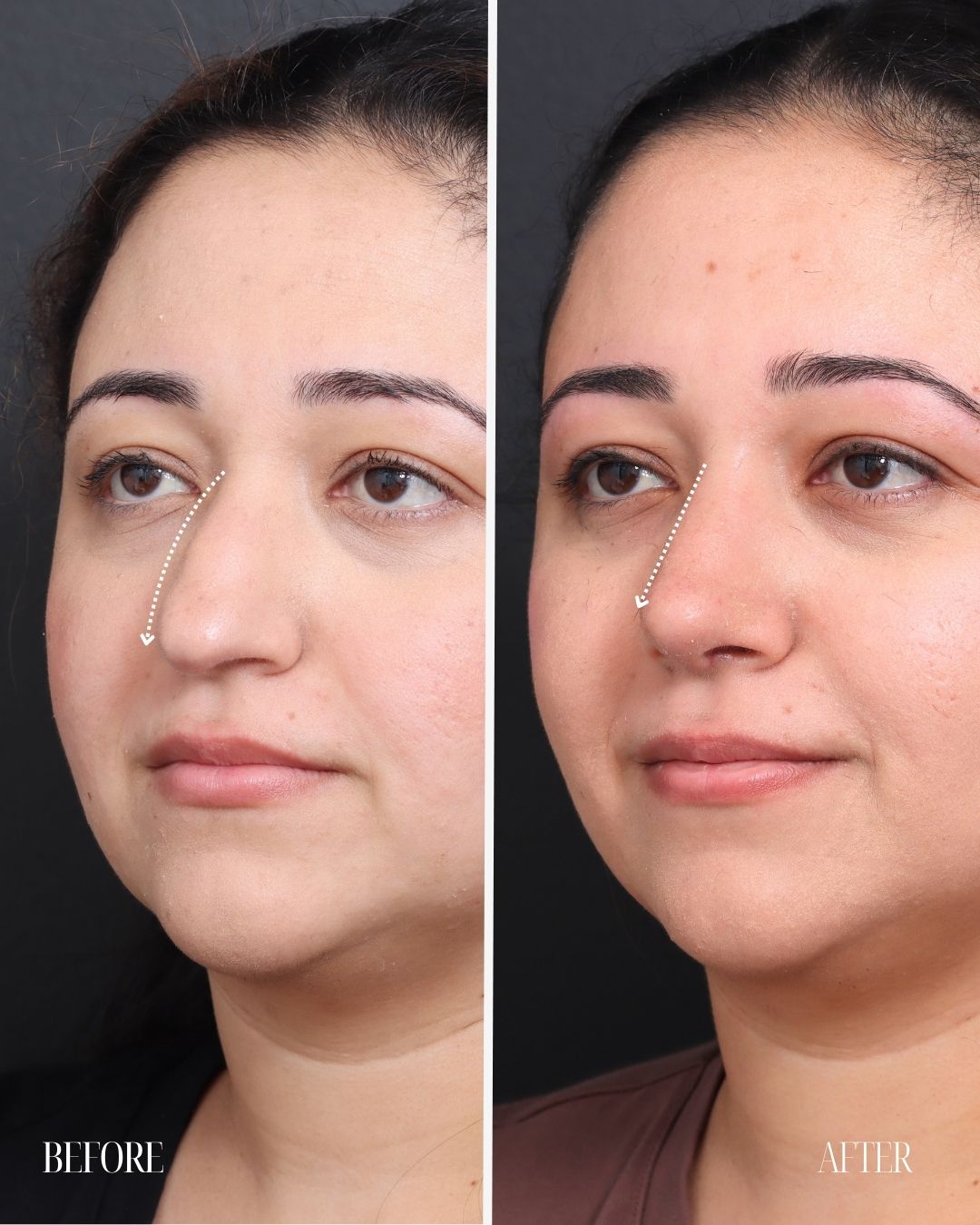 septoplasty-rhinoplasty-01-obl-left