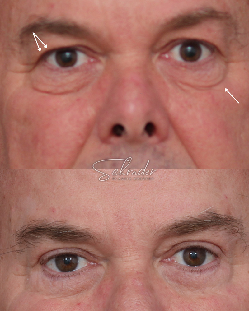 upper-and-lower-blepharoplasty-20-1