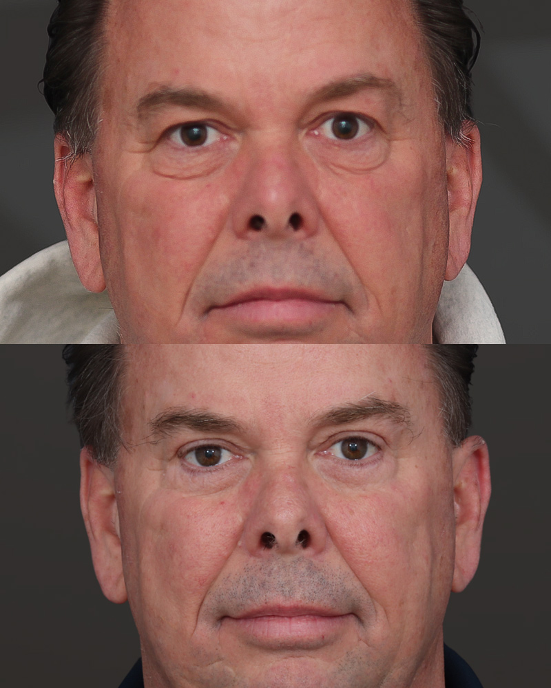upper-and-lower-blepharoplasty-20-2