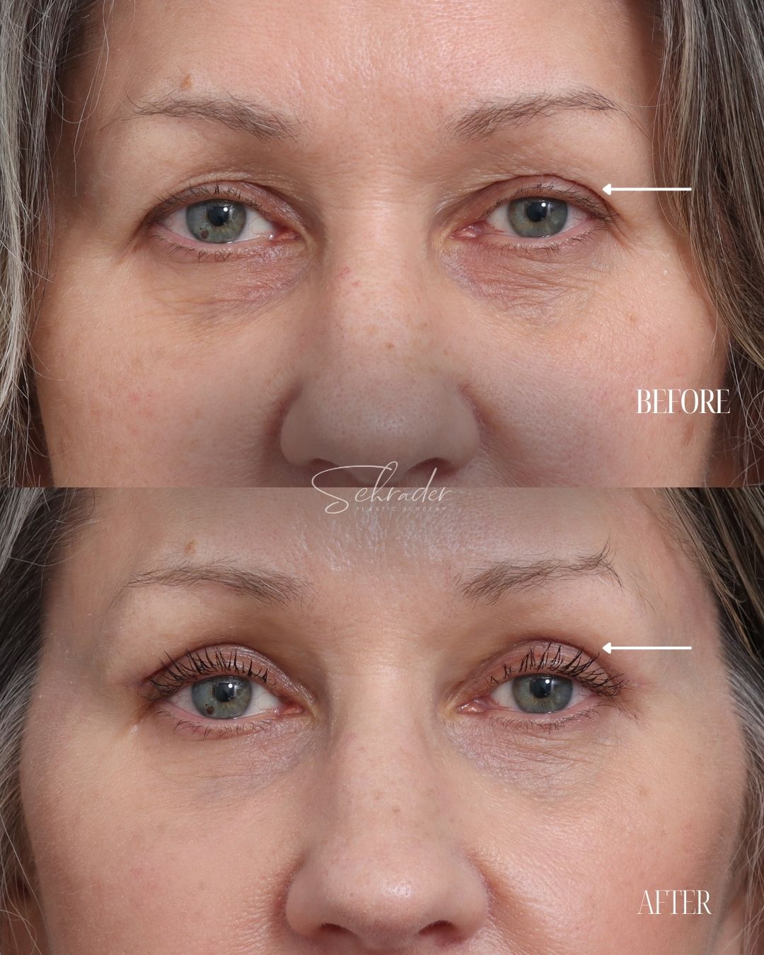 upper-blepharoplasty-02-front