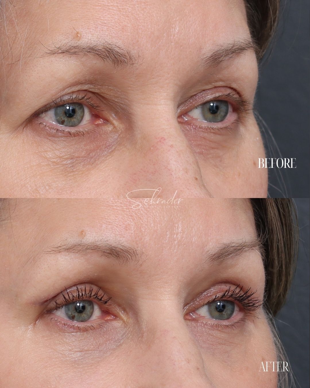upper-blepharoplasty-02-obl
