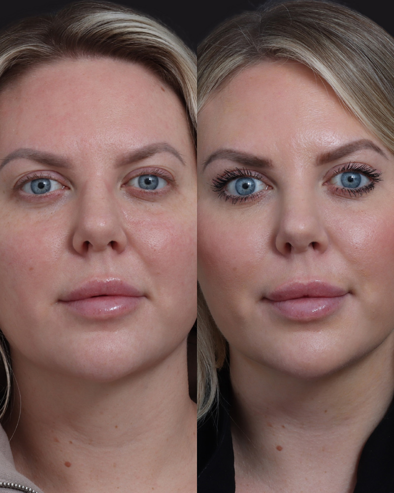 upper-blepharoplasty-12-front