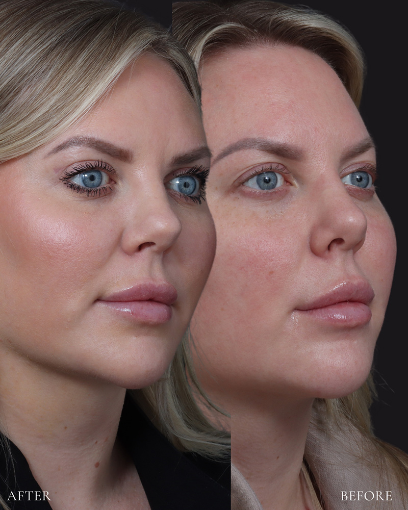 upper-blepharoplasty-12-obl