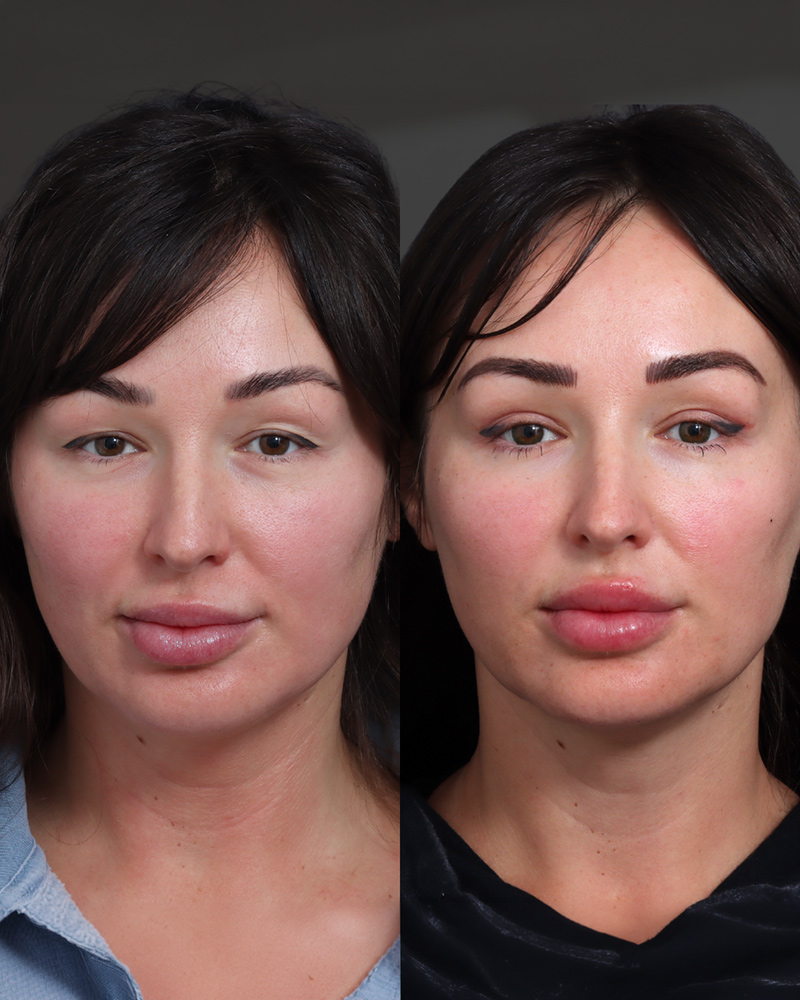 upper-blepharoplasty1