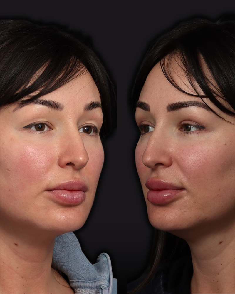upper-blepharoplasty2