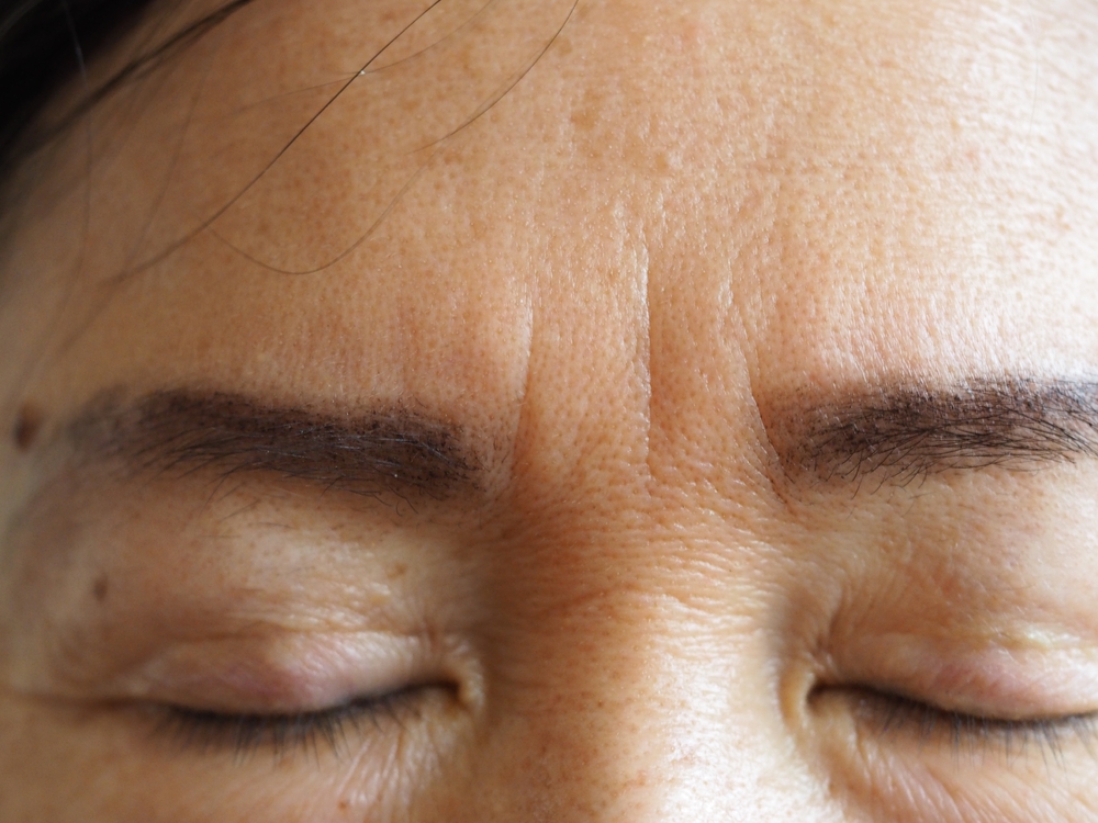 Close-up of forehead lines showing how repeated facial movement can create skin folds.