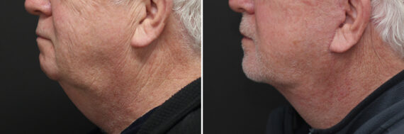Facelift Before and After Photos in Princeton, NJ, Patient 10975