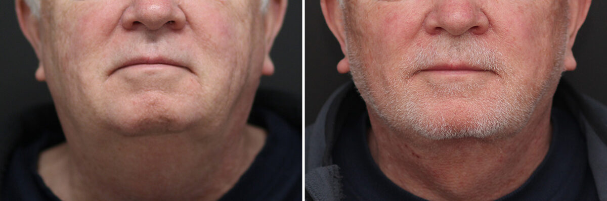Facelift Before and After Photos in Princeton, NJ, Patient 10975