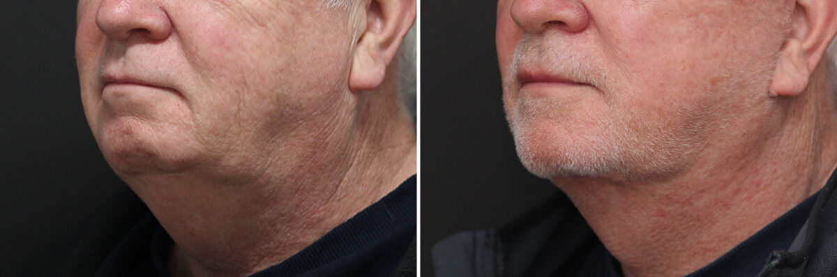 Facelift Before and After Photos in Princeton, NJ, Patient 10975