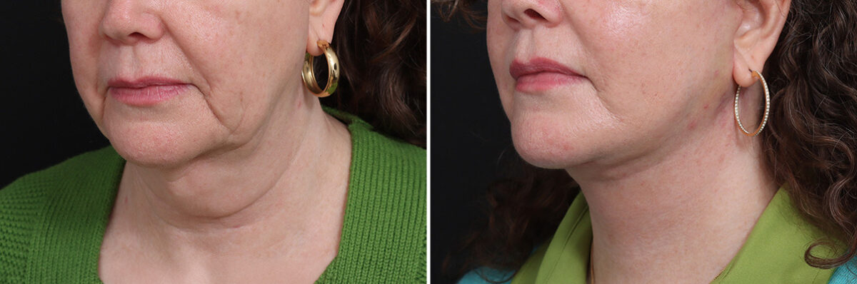 Facelift Before and After Photos in Princeton, NJ, Patient 17270