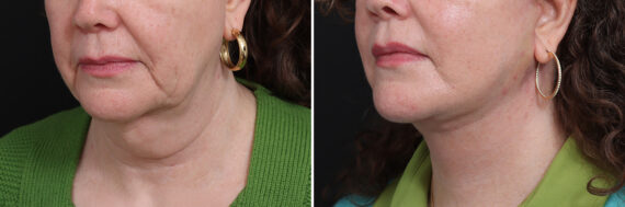 Facelift Before and After Photos in Princeton, NJ, Patient 17270