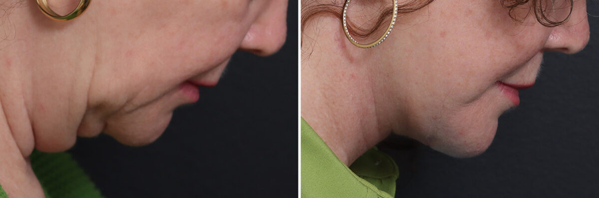 Facelift Before and After Photos in Princeton, NJ, Patient 17270