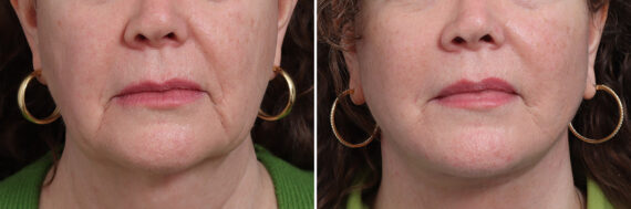 Facelift Before and After Photos in Princeton, NJ, Patient 17270