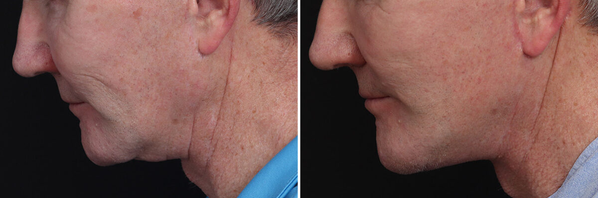 Chin Implants Before and After Photos in Princeton, NJ, Patient 19005