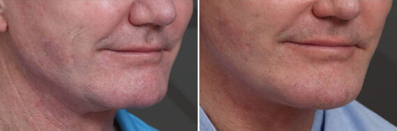 Chin Implants Before and After Photos in Princeton, NJ, Patient 19005