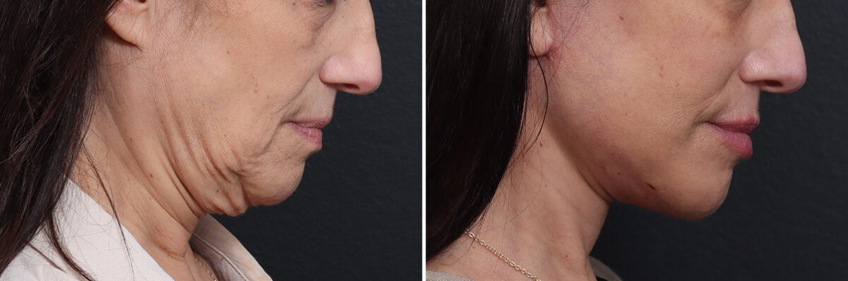 Deep Plane Facelift Before and After Photos in Princeton, NJ, Patient 19278