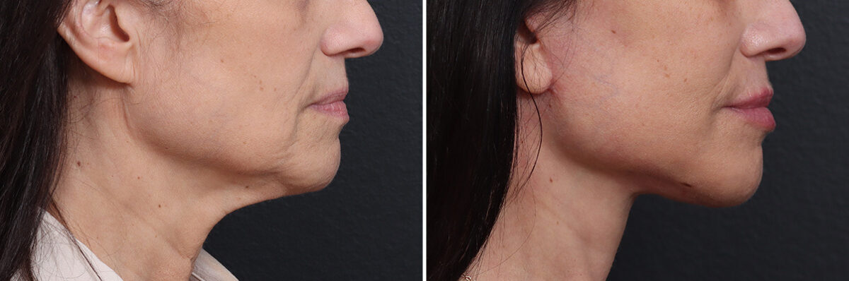 Deep Plane Facelift Before and After Photos in Princeton, NJ, Patient 19278