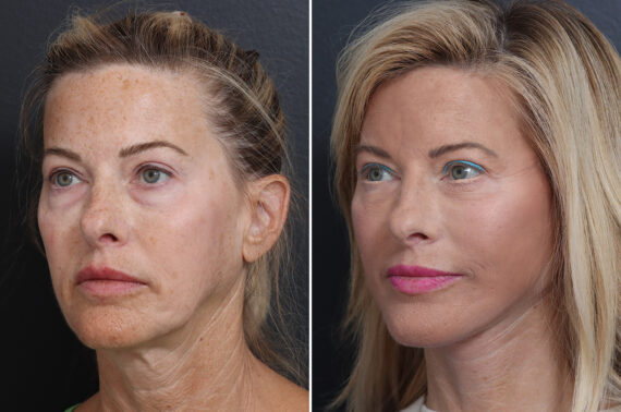 Deep Plane Facelift Before and After Photos in Princeton, NJ, Patient 19327