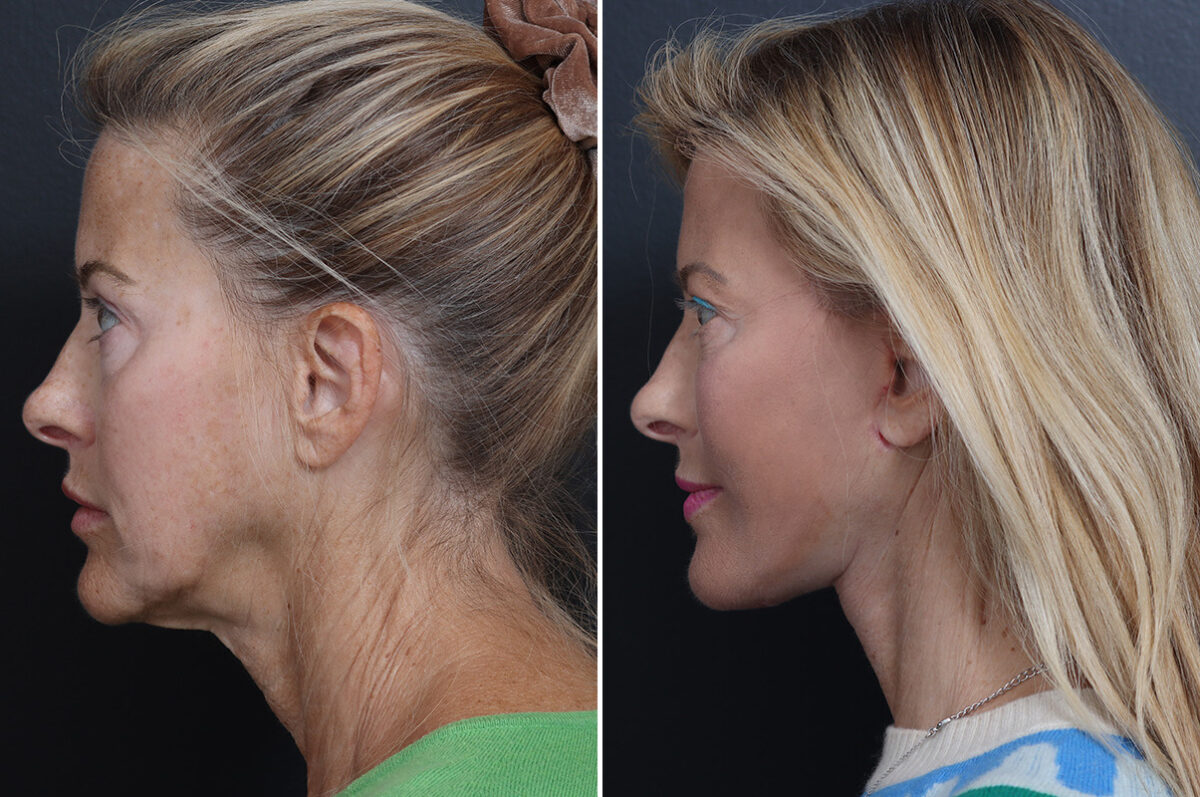 Deep Plane Facelift Before and After Photos in Princeton, NJ, Patient 19327