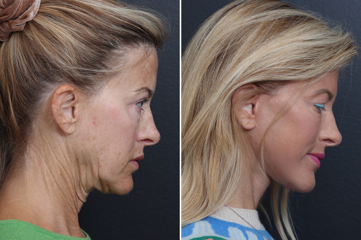 Deep Plane Facelift Before and After Photos in Princeton, NJ, Patient 19327