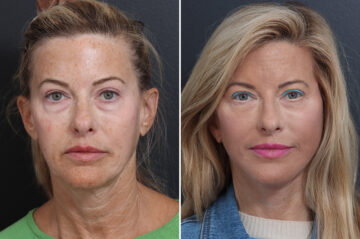 Deep Plane Facelift Before and After Photos in Princeton, NJ, Patient 19327