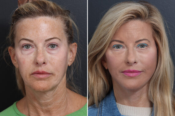 Deep Plane Facelift Before and After Photos in Princeton, NJ, Patient 19327