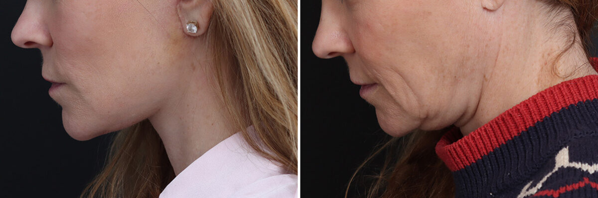 Facelift Before and After Photos in Princeton, NJ, Patient 20192