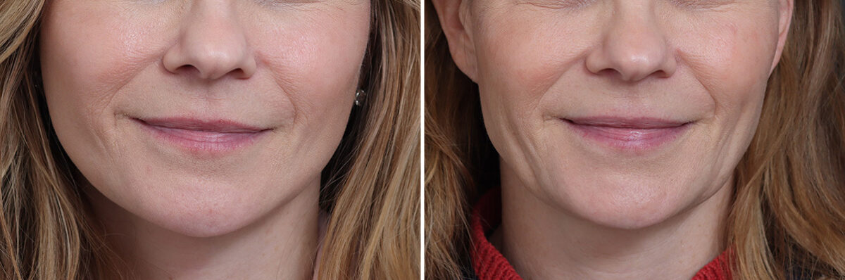 Facelift Before and After Photos in Princeton, NJ, Patient 20192
