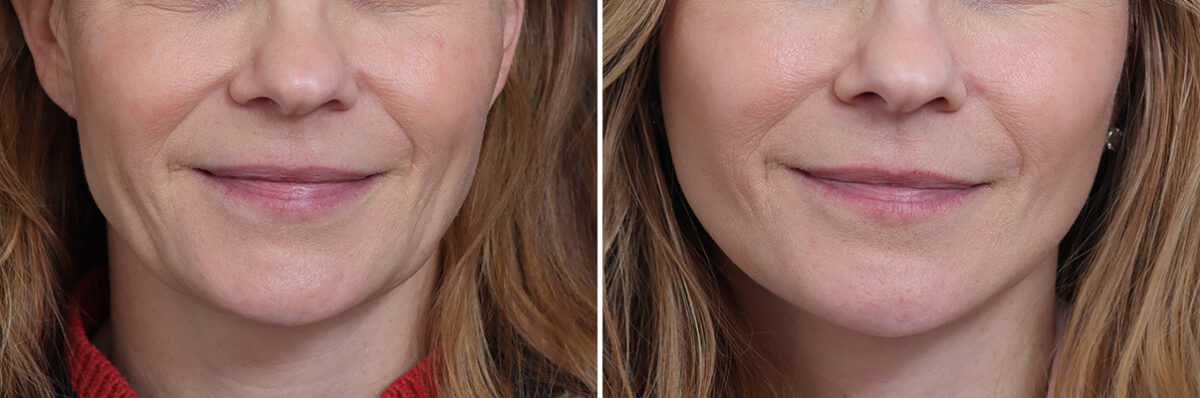 Facelift Before and After Photos in Princeton, NJ, Patient 20192