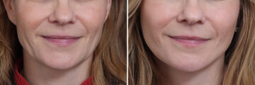 Facelift Before and After Photos in Princeton, NJ, Patient 20192