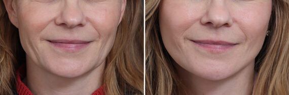 Facelift Before and After Photos in Princeton, NJ, Patient 20192