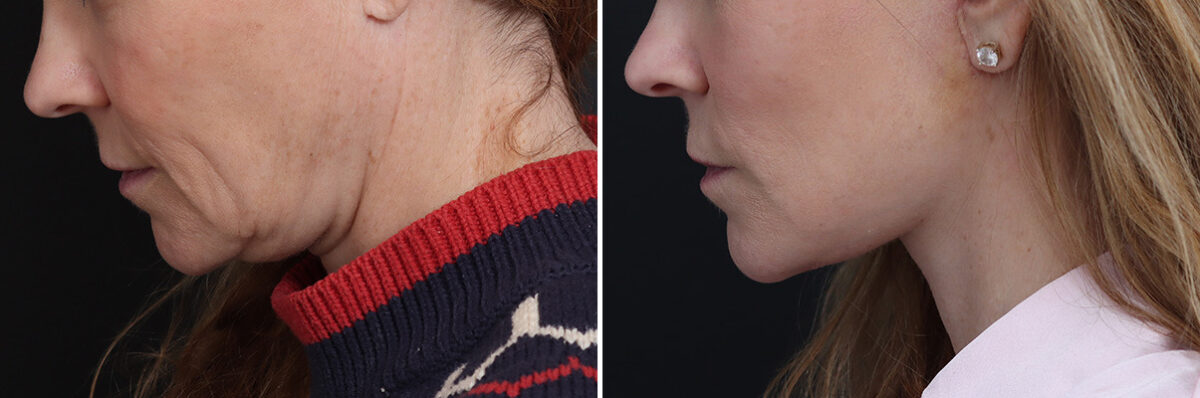 Facelift Before and After Photos in Princeton, NJ, Patient 20192