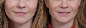 Facelift Before and After Photos in Princeton, NJ, Patient 20192
