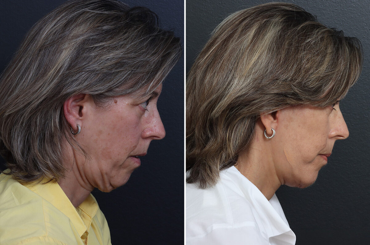 Facelift Before and After Photos in Princeton, NJ, Patient 20237