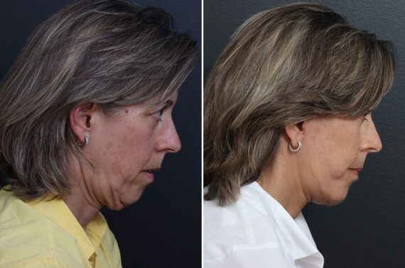 Facelift Before and After Photos in Princeton, NJ, Patient 20237