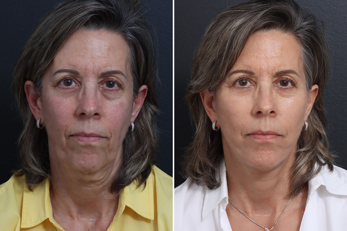 Facelift Before and After Photos in Princeton, NJ, Patient 20237